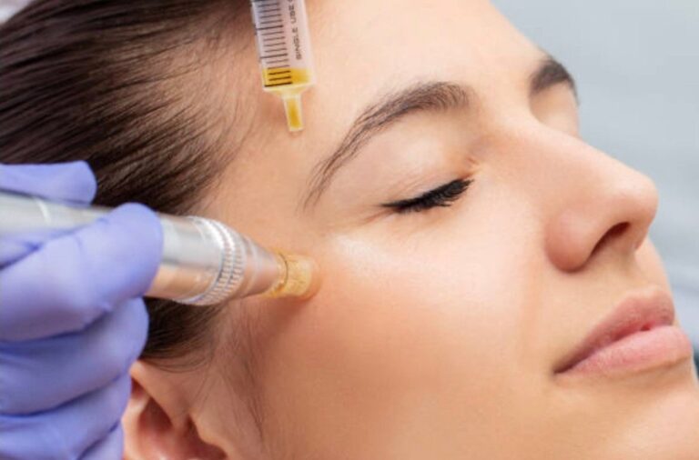 Microneedling in Woodstock