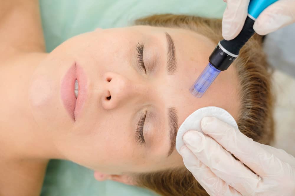 collagen induction therapy in microneedling